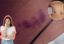 Marca de un chupetón en el cuello y sus posibles riesgos para la salud