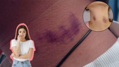 Marca de un chupetón en el cuello y sus posibles riesgos para la salud