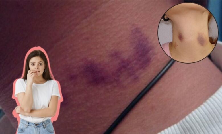 Adolescente muere tras recibir un “chup3tón” en el cuello, ¿cuáles son los riesgos de esta práctica? 1 Marca de un chupetón en el cuello y sus posibles riesgos para la salud