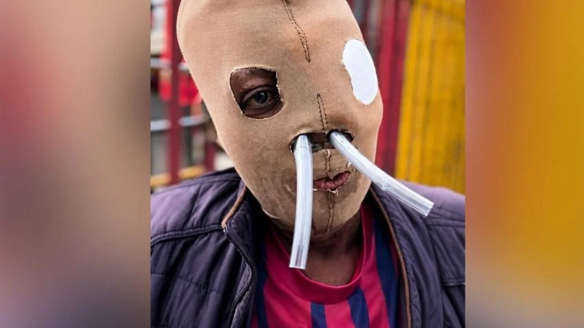 Autorizan eutanasia a María Consuelo, víctima de un at4qu3 con ácido y sometida a 87 cirugías