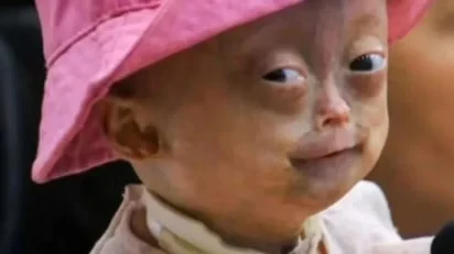 Elis Lima Carneiro, niña brasileña que padecía progeria